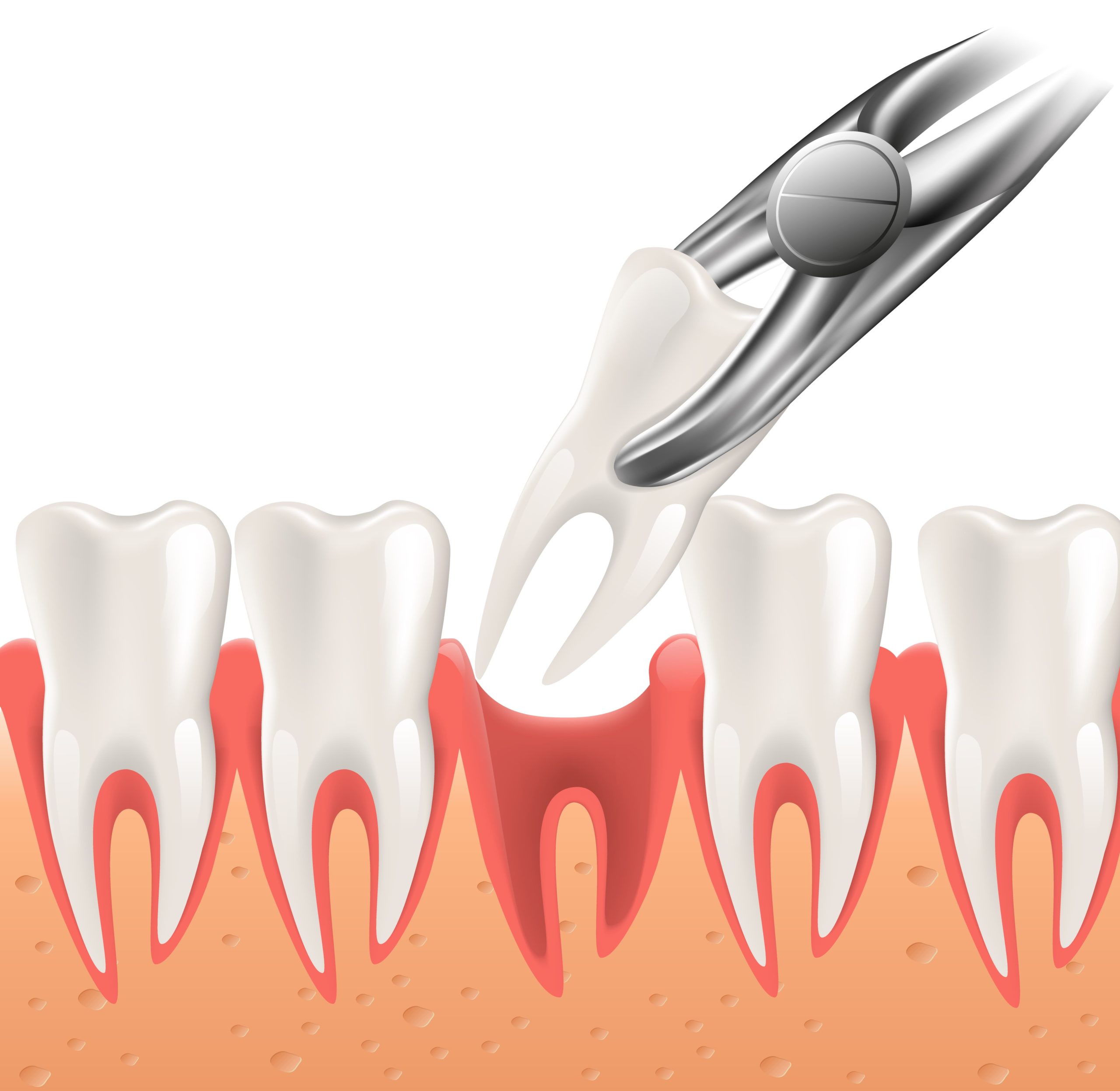 Illustration Tooth Extraction