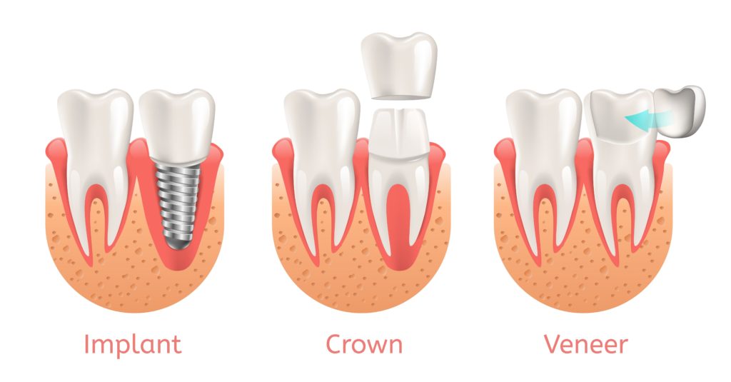 Illustration Tooth Restoration